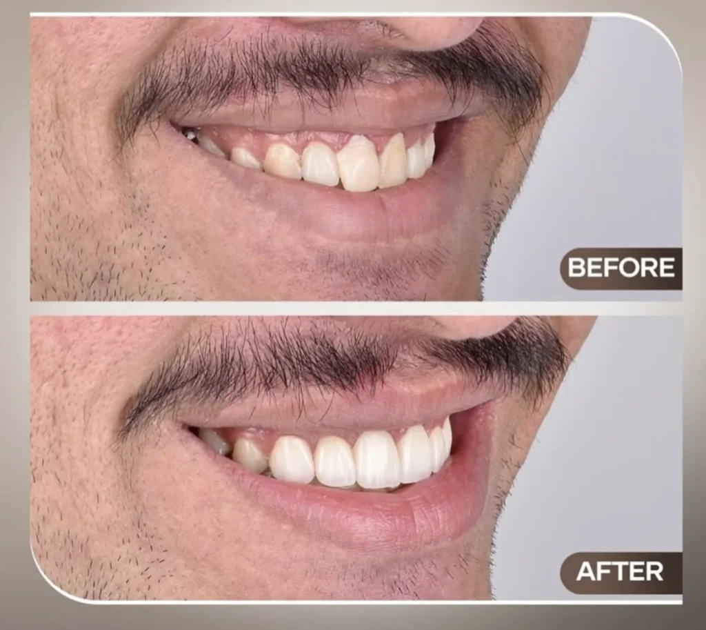 Early Stage Gum Disease: What Causes It and How to Prevent It?