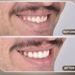 Early Stage Gum Disease: What Causes It and How to Prevent It?