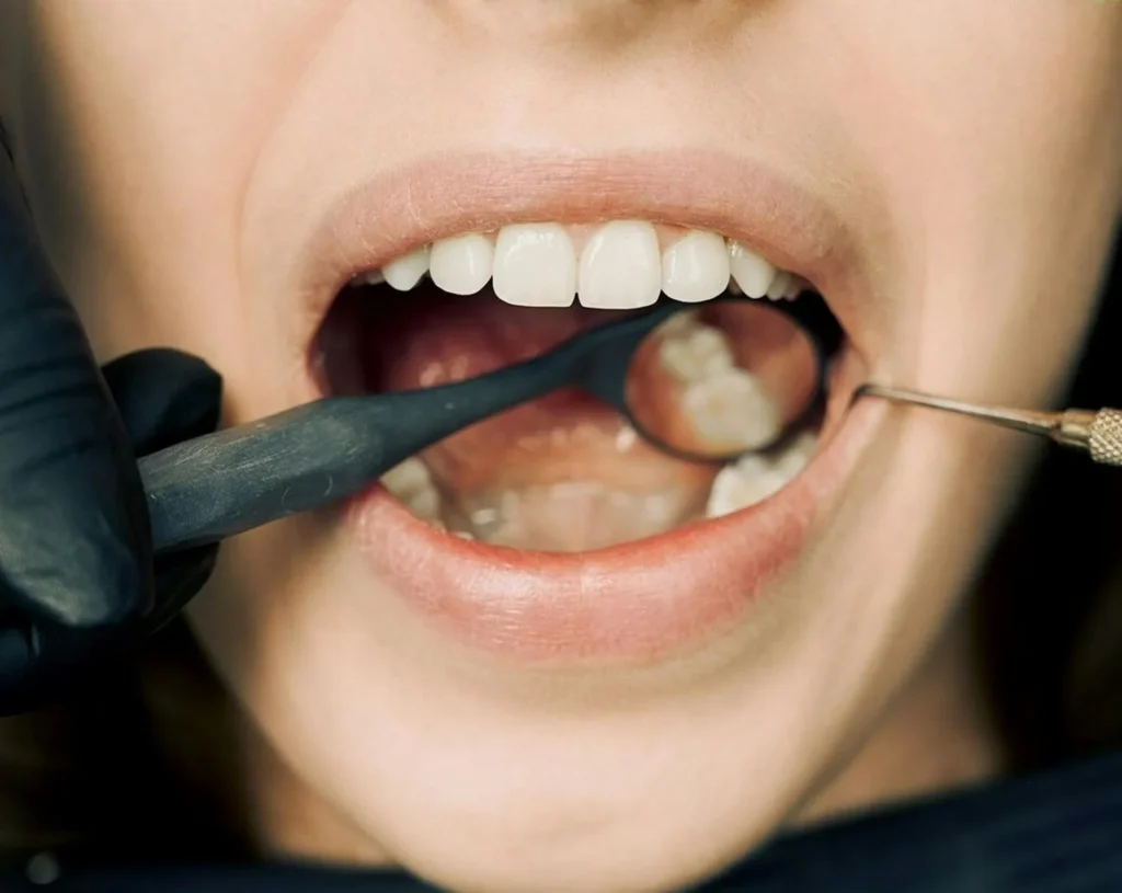 Early Stage Gum Disease: What Causes It and How to Prevent It?
