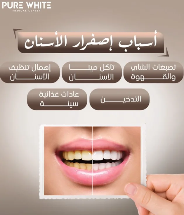 Illustration showing common causes of yellow teeth