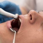 A dentist offering the dental filling treatment to a woman
