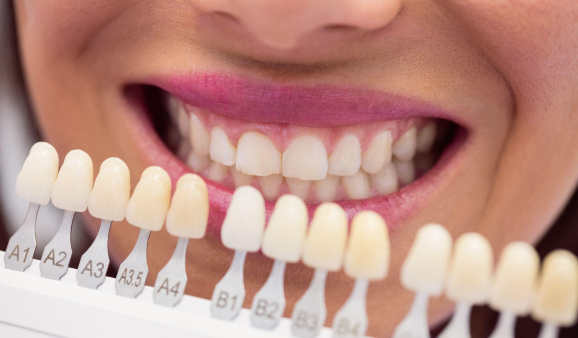 The veneer shade card in front of a woman’s teeth