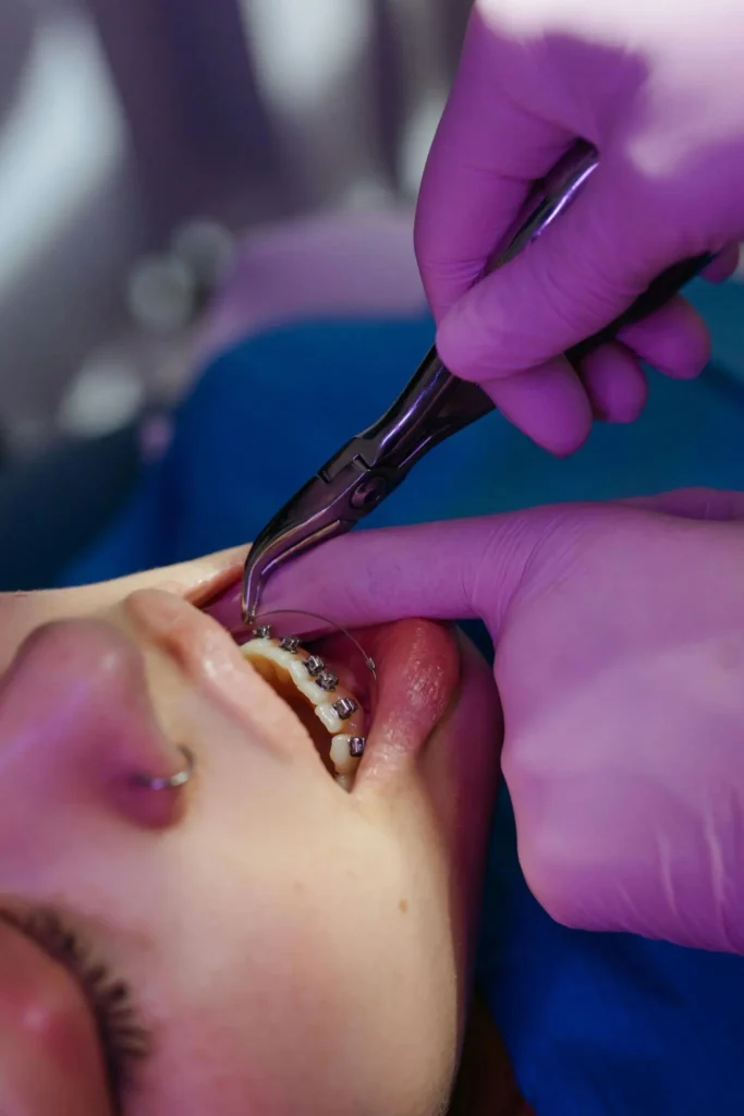 Braces on crooked teeth and results after orthodontic treatment