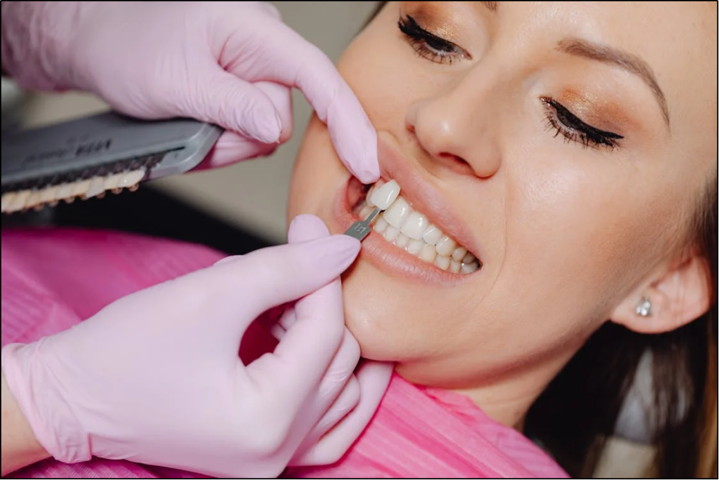 Crown vs Veneer Understanding Which Is Better for Your Teeth