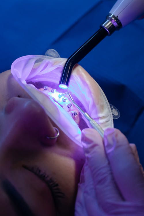 Crown vs Veneer Which Is Better for Your Teeth