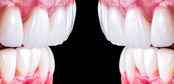 emax press ceramic veneers