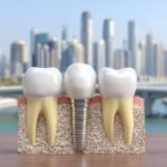 Dental Implants and Bridges