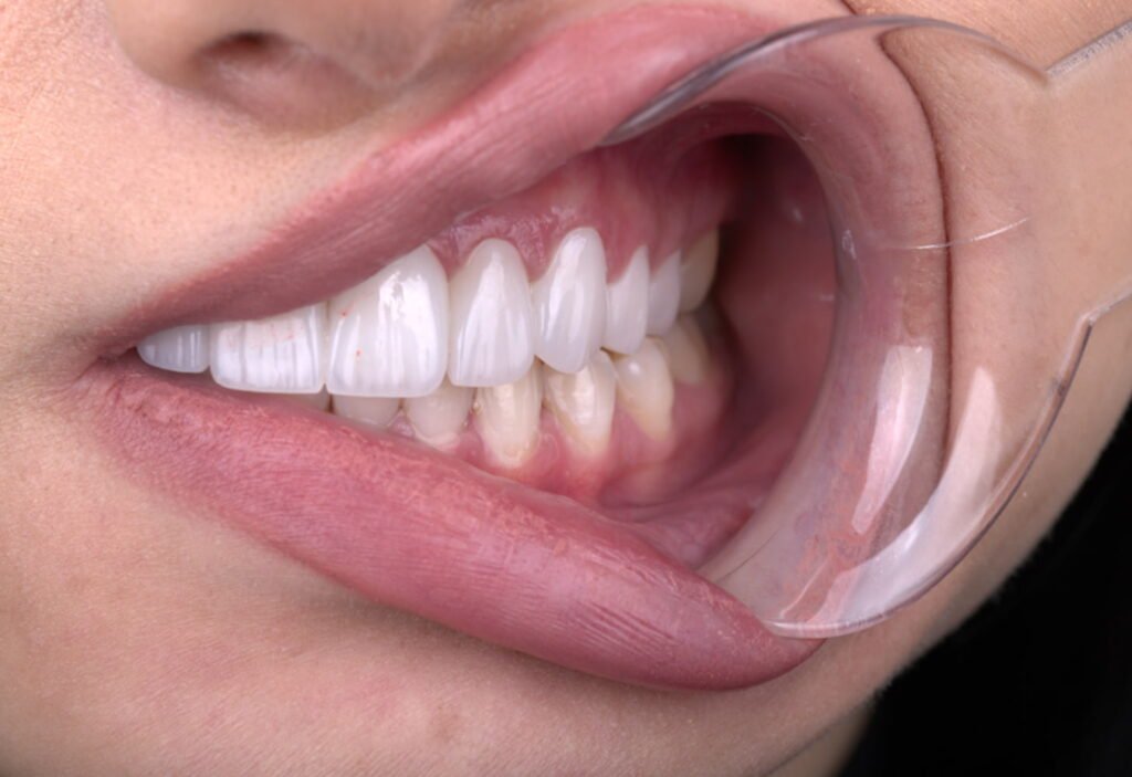 Close-up of gum contouring dental procedure