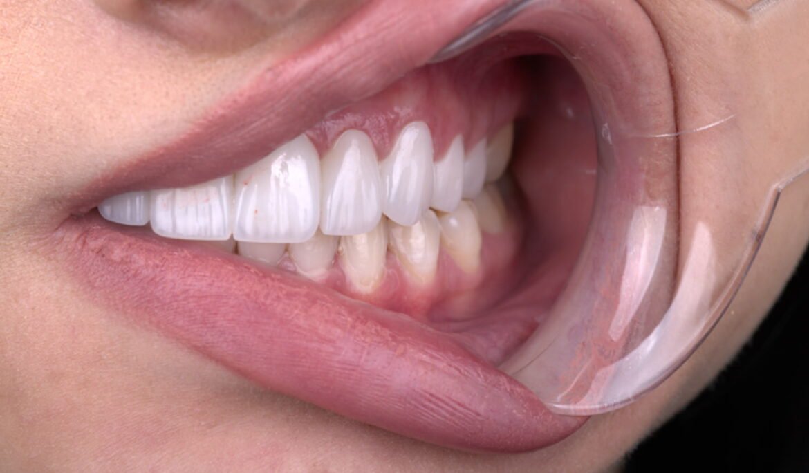 Close-up of gum contouring dental procedure