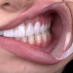 Close-up of gum contouring dental procedure
