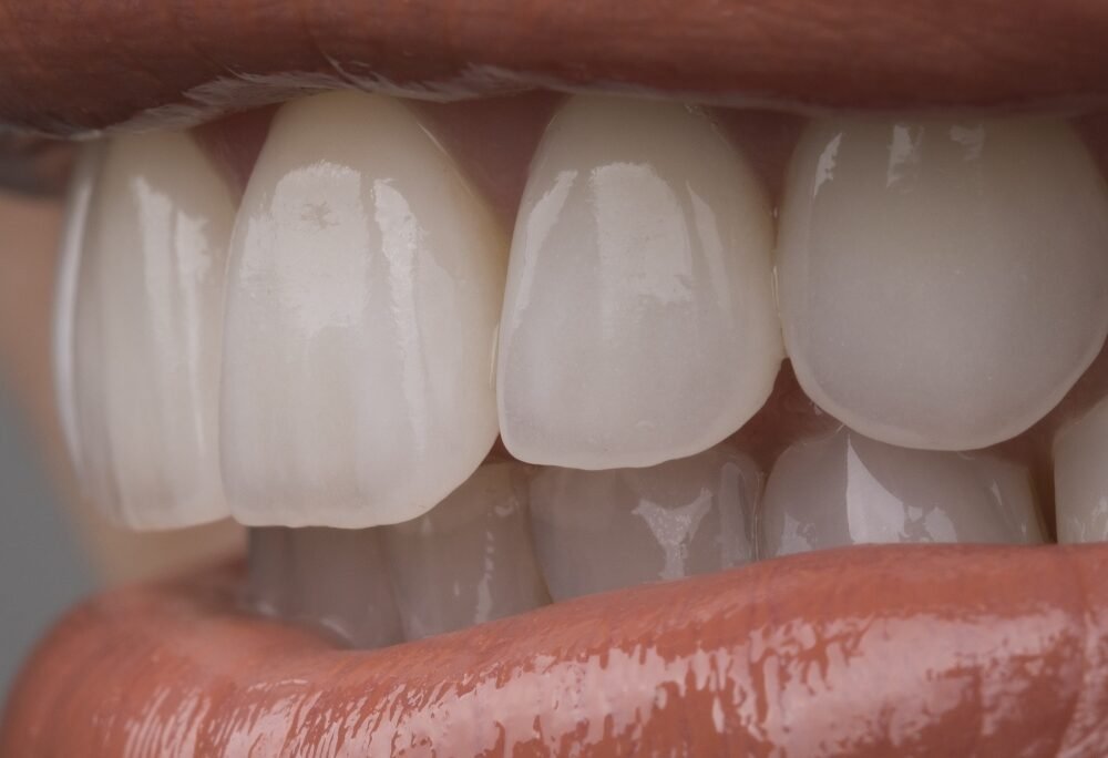 White teeth